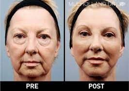 This procedure is quite expensive as a result of its complexity. Facial Fat Grafting In Toronto Facial Fat Transfer