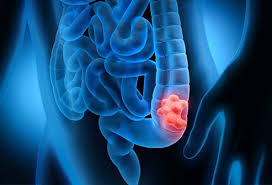How does the doctor know i have colorectal cancer? 8 Colon Cancer Early Warning Signs And Stages