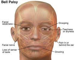 You can repeat them 30 times each, up to 4 times a day. Physical Therapy Guide To Bell S Palsy Choosept Com