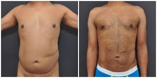 Best San Francisco Male Liposuction Plastic Surgeon Near Me Sieber Plastic Surgery