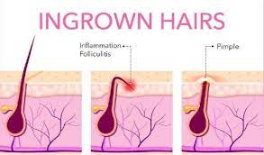 Ingrown hairs can be found on any part of the body that has hair and can. Stop Ingrown Hairs From Recurring Nina L Allure