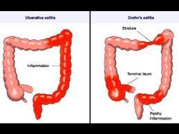 This animation describes the cause, symptoms, and factors in the development of crohn's disease, a type of inflammatory bowel disease (ibd). Crohn Disease Youtube