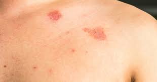 Et vanlig symptom på sopp i underlivet er utflod. Soppinfeksjoner I Huden Lommelegen