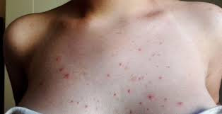 Sindromi reattive da solfiti una sindrome asmatica può essere indotta frequentemente anche dai solfiti (e220, e228), largamente utilizzati nell'industria alimentare, per le loro proprietà antisettiche ed antiossidanti, in vini, birre, formaggi, bevande alcoliche, succhi di frutta, frutta secca, crostacei e soprattutto preparazioni di patate, in particolare nelle patate surgelate a pezzi per. Buono Senza Sale Dermatite