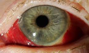 Für rote augen kommen unterschiedliche ursachen infrage. Das Rote Auge Blinden Und Sehbehindertenverband Wnb
