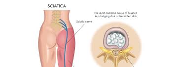 Tens Unit Therapy For Sciatica Pain Pain Doctor