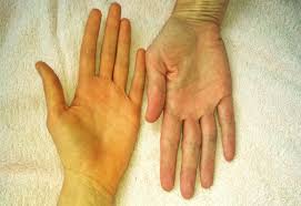 Da bị v&agrave;ng c&oacute; nguy hiểm kh&ocirc;ng? C&aacute;ch điều trị da v&agrave;ng như thế n&agrave;o?