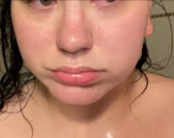 What helps with redness