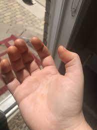 Maybe you would like to learn more about one of these? Page 2 What Are These Orange Stains That Have Appeared On My Hands Overnight Gransnet