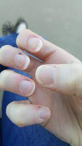 We did not find results for: Skin Concerns How Do I Fix The Dry Cracked Peeling Skin Around My Nails Skincareaddiction