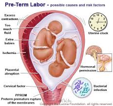 Image result for Preterm Labor Management