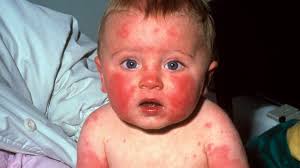 Image result for vyrážka u dětí