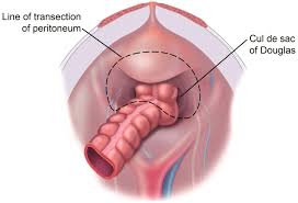 The proper indication for the nutritional support of the incurable cancer patients relies on many factors. Gastric Cancer Prevention And Treatment Of Peritoneal Metastases