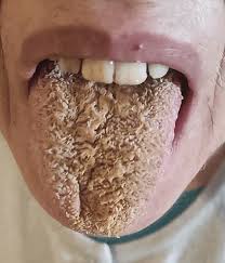 Image result for black hairy tongue symptoms
