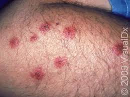 Image result for bedbugs bites