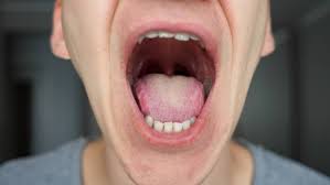 Image result for yellow tongue infection