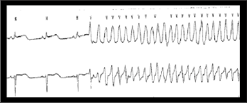 However, if an ectopic focus depolarises early enough — prior to the arrival of the next sinus impulse — it may capture the ventricles, producing a premature contraction. Rhythm Strip Showing Sinus Bradycardia With Premature Ventricular Download Scientific Diagram