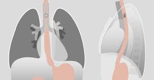 Because its electric conductivity is too poor to detect it as. Swallowed Foreign Bodies Radiology Key