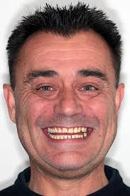 Composite Injection Technique (F.I.T.) Course (On-Demand)