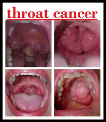 For instance, voice changes may be a sign of laryngeal (voice box) cancer, but they would rarely indicate cancer of the pharynx. Throat Cancer Symptoms In Women Celine Dion Songs Age