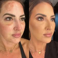 Mika Wright, BSN RN (@mika_aesthetic_nurse_injector) · Cape Girardeau, MO