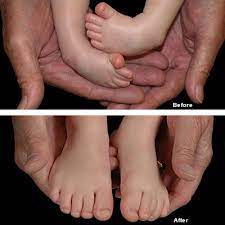 Even with treatment, clubfoot may not be totally correctable. Clubfoot Shriners Hospitals For Children St Louis