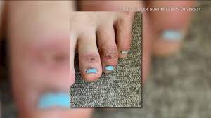 Covid nails are increasingly being recognized as the nails recover after infection. Doctors Report Covid Toes Discolored Skin On Some Coronavirus Patients Abc7 New York