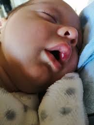 Check spelling or type a new query. Newborn Red Blister On Lip Mumsnet