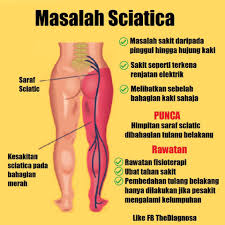 Banyak penyakit yang termasuk sakit saraf. Klinik Avicenna Anda Ada Sakit Daripada Bahagian Pinggul Turun Ke Hujung Kaki Dan Sakit Tersebut Seolah Olah Macam Terkena Elekterik Atau Ditembak Anda Sebenarnya Mungkin Menghadapi Masalah Yang Dinamakan Sebagai Sciatica Ia