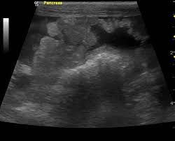 A golf ball) in their bowl. Working Through The Ascites On Ultrasound Our Case Of The Month April 2014 Sonopath