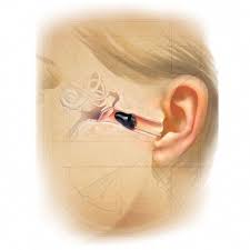 Pin On Menieres Disease And Tinnitus