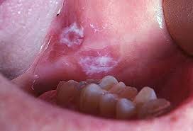 Hairy leukoplakia of the mouth is an unusual form of leukoplakia that is seen only in people who are the presence of white or gray colored patches on your tongue, gums, roof of your mouth, or the inside how is leukoplakia treated? Mouth Problems Tmj Canker Sores Painful Gums And More