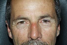 Custom-Made Prosthetic Eyes