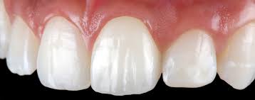 Check spelling or type a new query. Cementation And Bonding Of Zirconia Restorations Volume 39 Issue 4 Zirconia Optimized