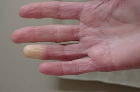Ada banyak penyebab di balik kondisi tersebut, dari yang ringan hingga berat. Telapak Tangan Dan Kaki Sering Kedinginan Waspadai Sindrom Raynaud