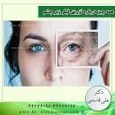 نتیجه تصویری برای تزریق فیلر در ناحیه زیر چشم