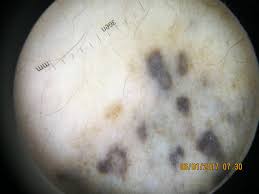 Image result for Blue Nevus