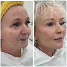 Signature Liquid Lift. It's all the little things✨✨✨✨✨ THAT MAKE THE  BIGGEST DIFFERENCE… 💥 Small changes. BIG RESULTS. Liquid Face Lift Points.  Brow bone. Temple hollows. UnderEyes. Cheekbones. Cheek fat pads. Alar