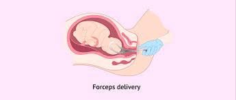 Image result for Forceps Assisted Delivery