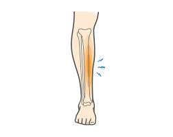 Image result for Shin Splints