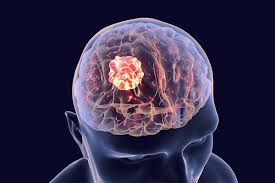 Brain Tumors - Onno Health