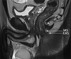Mri patterns of neuromuscular disease involvement thigh & other muscles 2. Mri Of The Male Pelvic Floor Radiographics