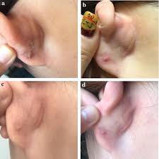 A hypertrophic scar is a thick and raised scar in which the excess tissue remains within the boundaries of the original injury. Retrospective Study Of Immediate Postoperative Electron Radiotherapy For Therapy Resistant Earlobe Keloids Springerlink