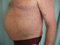 Check spelling or type a new query. Leucemia Cutis Hoogstra Centros Medicos