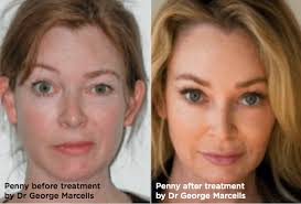 In bell's palsy, this nerve becomes compressed due to swelling and inflammation that is a part of the body's reaction to an infectious disease process. Treatment Options For Bell S Palsy Dr George Marcells