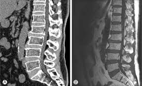 Compression fractures are the most common type of fracture affecting the spine. Neurospine