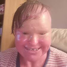 Woman whose skin grew too fast for her body dies at 32