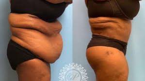 How much is a bbl in chicago. Brazilian Butt Lift Chicago Nw In Petrungaro Plastic Surgery