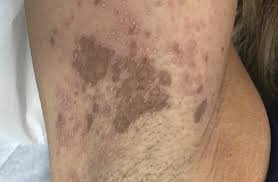 Image result for Diffuse Hyperpigmentation