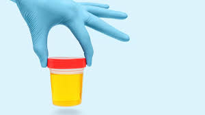 Urine yang sehat umumnya berwarna kuning pucat atau seperti warna madu. Penyebab Urine Berwarna Kuning Setelah Minum Vitamin